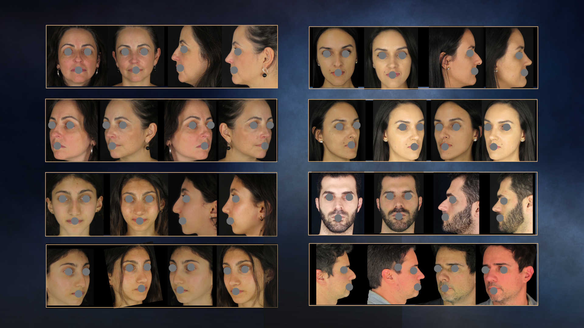 Exemplo educativo de resultado de rinoplastia